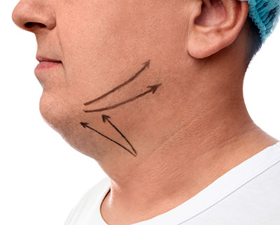 Man with lines drawn on sagging neck