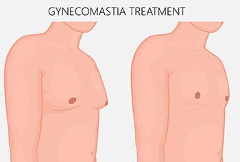 Before and after gynecomastia treatment