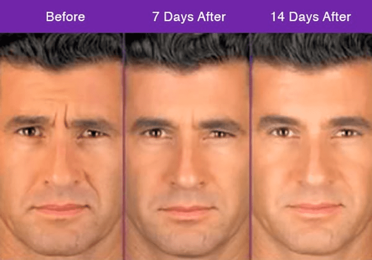 Progression of facial changes after receiving Botox