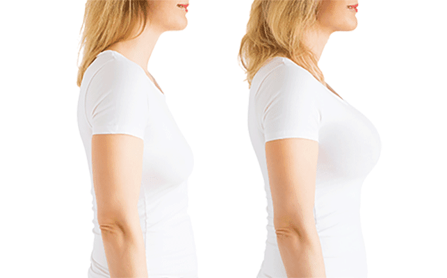 Breast Augmentation, Breast Implants