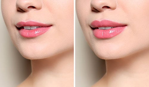 Lip Augmentation Before and After pictures