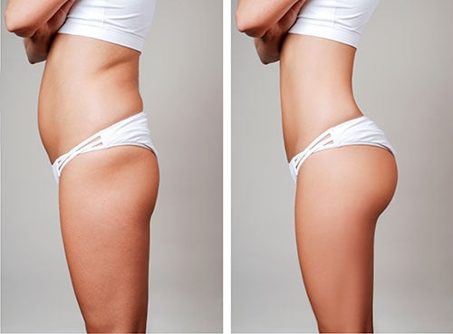 Women's Liposuction –