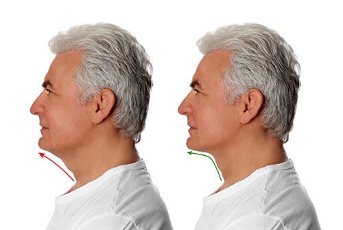 Neck liposuction Before and After picture 