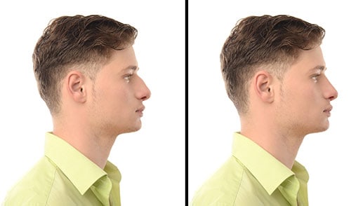 Rhinoplasty Nose Job Before & After Picture