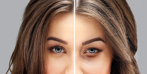 Close up of a woman's face before and after eyelid surgery