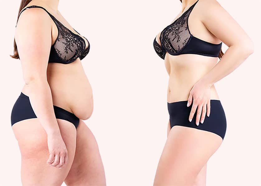 Plus Size Tummy Tuck Surgery Before & After Photo Gallery