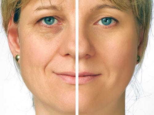 Facelift Before & After pictures of woman