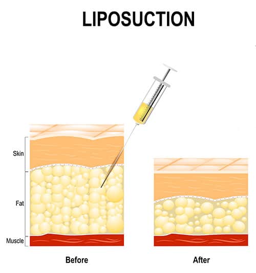 Illustration of liposuction