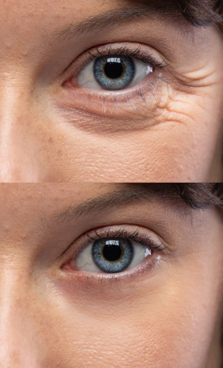 Eyes with crow's feet before and after treatment