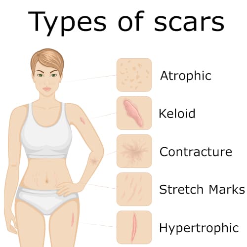 Illustration of scar types