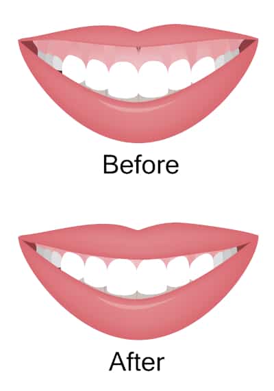 Gummy smile before and after