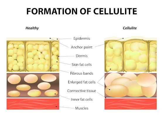 Researchers Finally Find A Cause For Cellulite Dimples