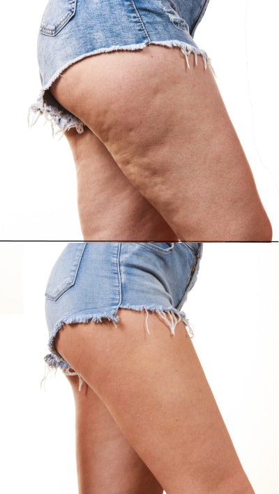 Researchers Finally Find a Cause for Cellulite Dimples!