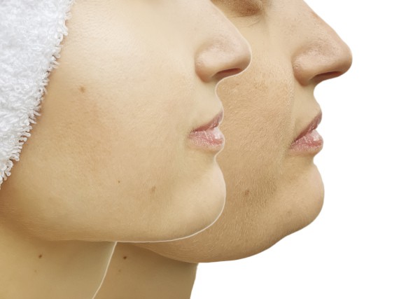 KYBELLA VS LIPOSUCTION: HOW TO GET RID OF A DOUBLE-CHIN