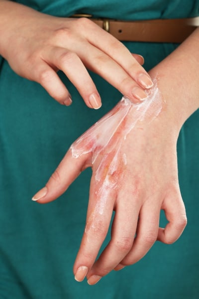 Applying burn cream to an injury