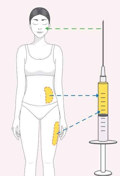 Facial Fat Transfer