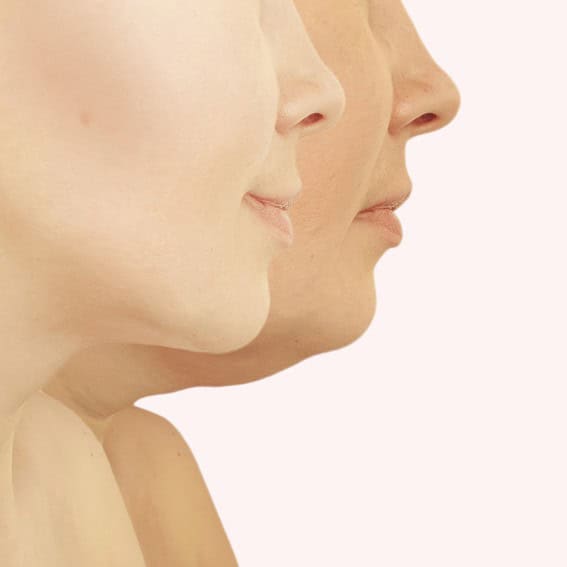 Neck Lift Plastic Surgery