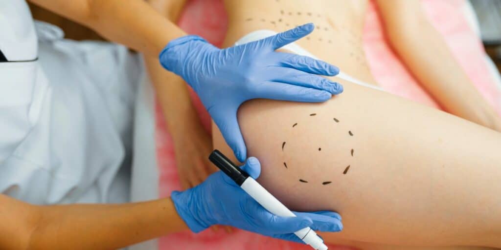 What You Need to Know About a Brazilian Butt Lift (BBL) Reduction