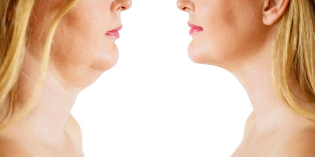 Redesigning double chin with neck contouring, before and after.