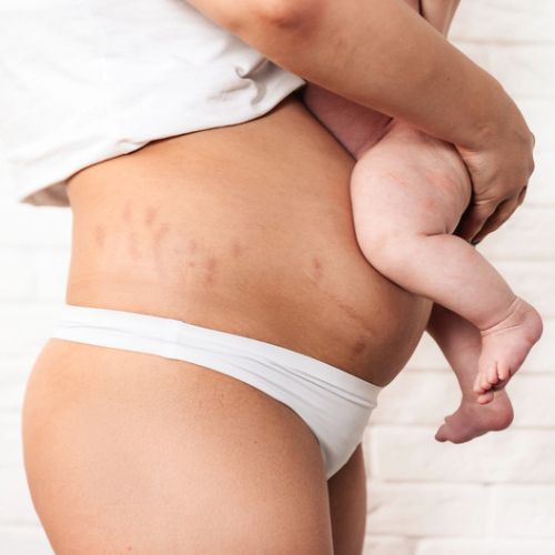 Mother holding baby, Why do moms with older children choose mommy makeovers?
