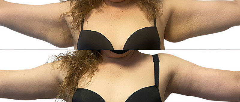 Woman's arms before and after lipedema treatment at Saber Plastic Surgery.