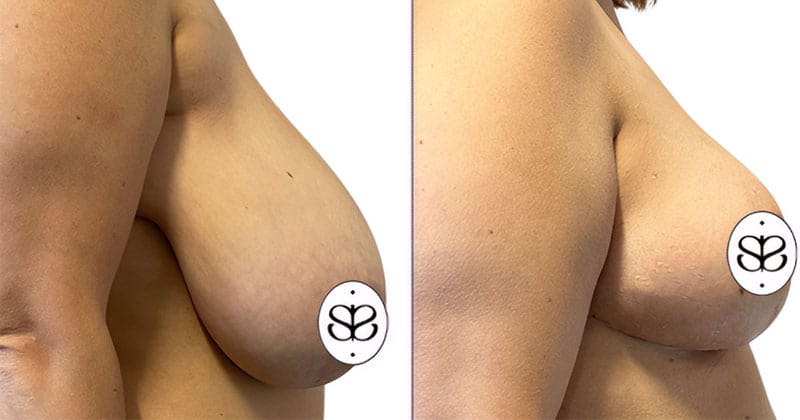 Side-by-side comparison of lipedema treatment results on the legs and hips.