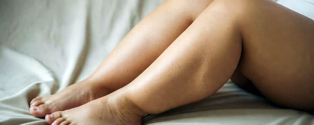 Woman's legs with lipedema, showing swelling and fat buildup.
