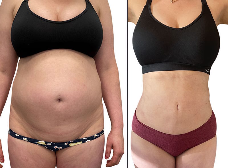 Lipo-360-Before-after-v3-800-IMG_9763