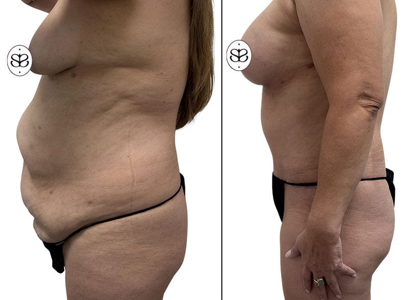 Before and after lipedema treatment in Los Angeles showing improved leg and thigh contour.