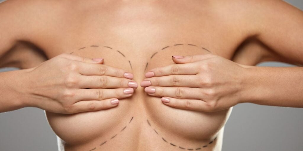 Close-up of a woman’s chest with dotted lines for breast augmentation surgery.